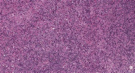 Ebv Positive Diffuse Large B Cell Lymphoma Atlas Of Pathology