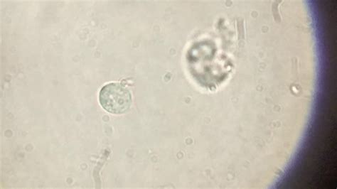 Std Vaginal Trichomoniasis In Urine Sedimen Microscopy Youtube