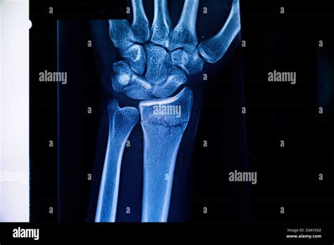 Radiography Examination Of Radius Fracture X Ray Human Arm X Ray Of