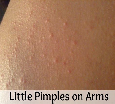 Little Pimples On Arms Remedies Corner Natural Beauty Pinterest