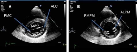 Parasternal Short Axis Views A At The Level Of Mitral Valve Showing