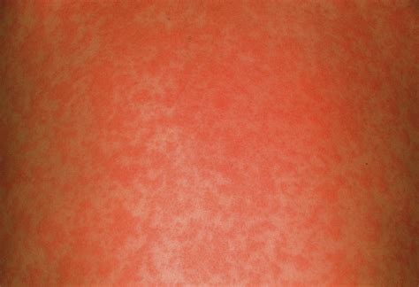 Measles Rash Photograph By Cnriscience Photo Library Fine Art America