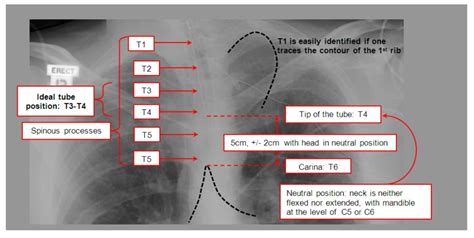 23 Essentials Of Intubation Paine Podcast And Medical Blog