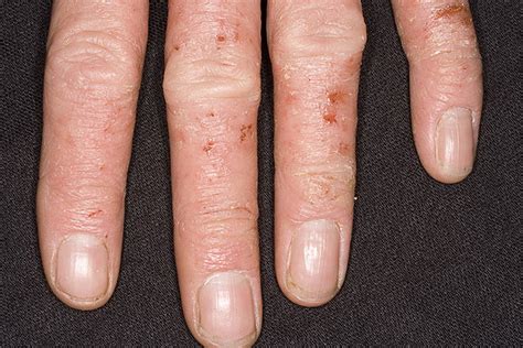 Microbial Eczema On Hands Pictures 54 Photos And Images