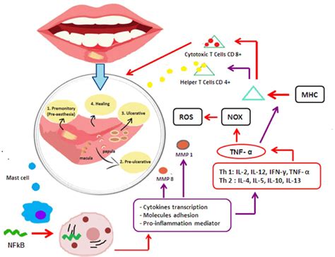 Inflammation Process Induced Recurrent Aphthous Stomatitis Ras