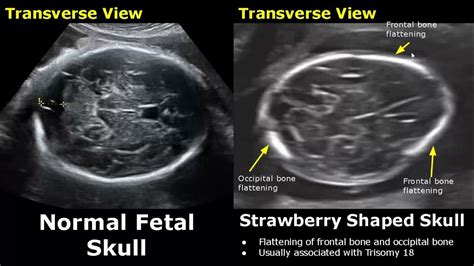 Fetal Head Ultrasound Normal Vs Abnormal Images Cloverleaflemon
