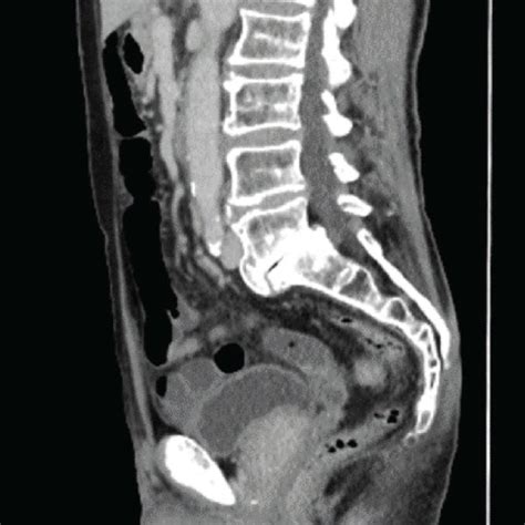 Contrast Enhanced Abdominal Ct Scan Sagittal Section Enhanced