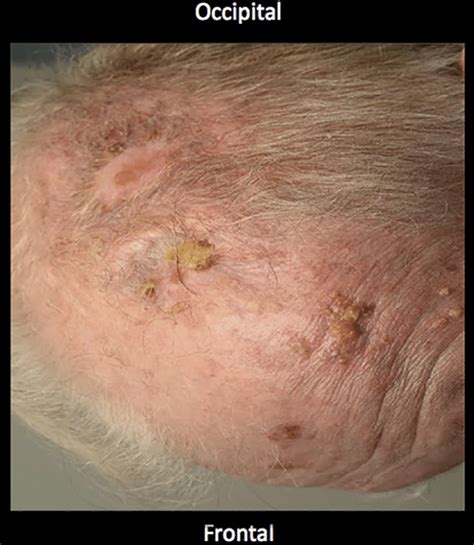 Photograph Of Scalp Pg Lesion Over Time January 2016 Download