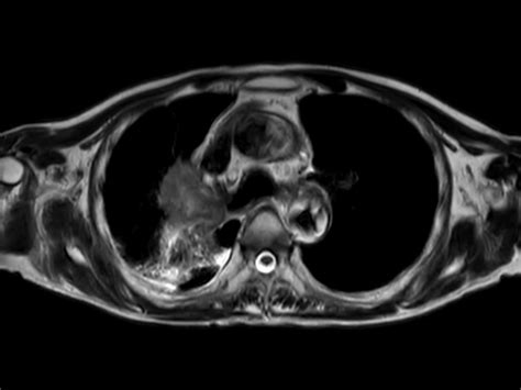 Lung Cancer Philips Mr Body Map