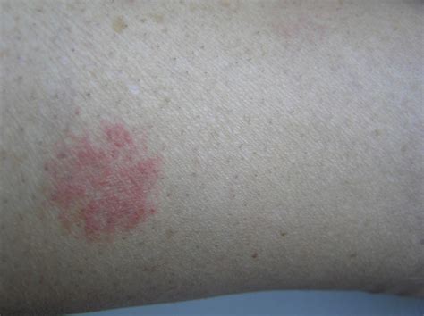 Circular Rash On Leg