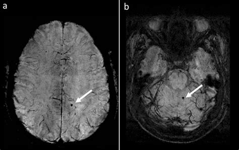 Cerebral Microbleeds In Ms Patients Associated With Increased Risk For