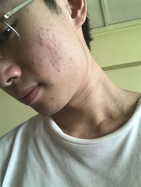 Acne Marks Or Scars How To Deal General Acne Discussion