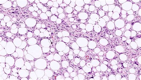 Pathology Outlines Myxoid Pleomorphic Liposarcoma