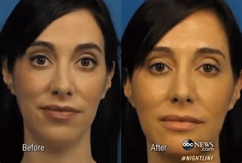 The Selfie And Cosmetic Surgery