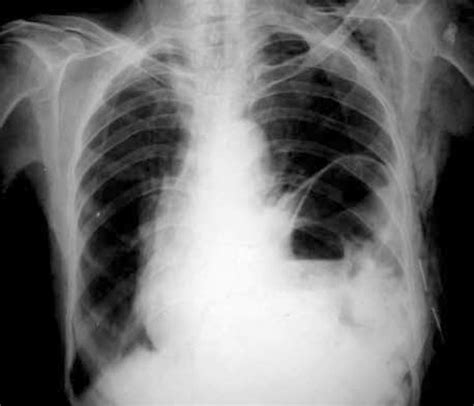 Hiatal Hernia Chest X Ray