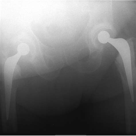 Postoperative X Ray After Extended Trochanteric Osteotomy Eto And