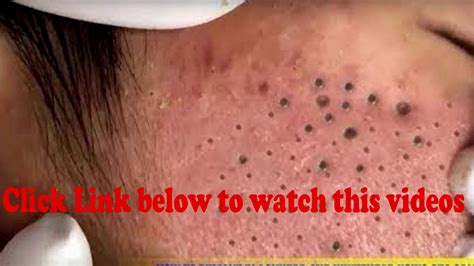 How To Removal Cystic Acne Blackheads And Whiteheads Acne Treatment