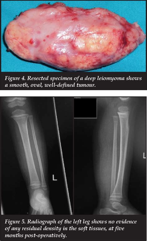 Pdf Leiomyoma Of The Calf Muscle In A Child With Calcification And