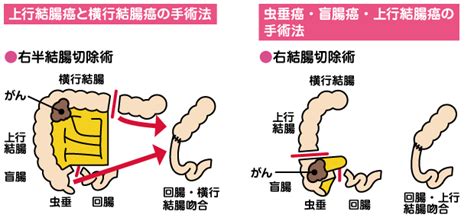 So just play and have a good time. 大腸 癌 ステージ3 - Hello Doctor