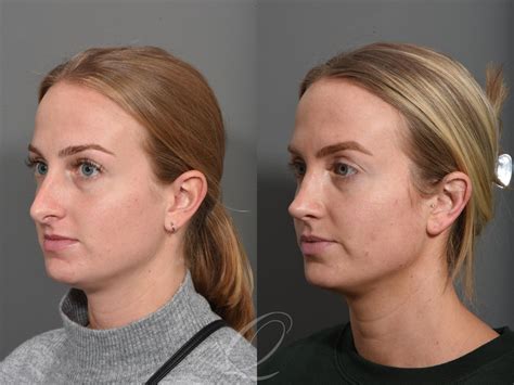 Rhinoplasty Before And After Photos Patient 1502 Serving Rochester