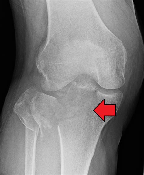 Recovering From A Tibial Plateau Fracture A Physiotherapy Perspective