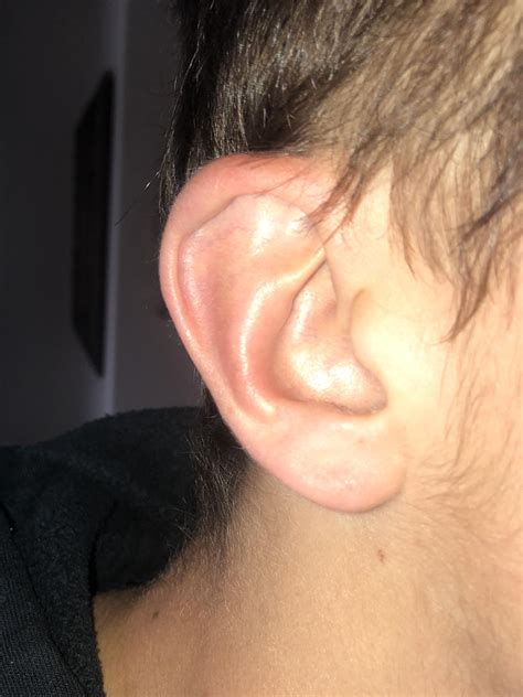 At What Point Should I Start Draining Ive Had This Hematoma On My Ear