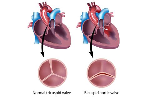 Bicuspid Aortic Valve Conditions And Treatments Ur Medicine