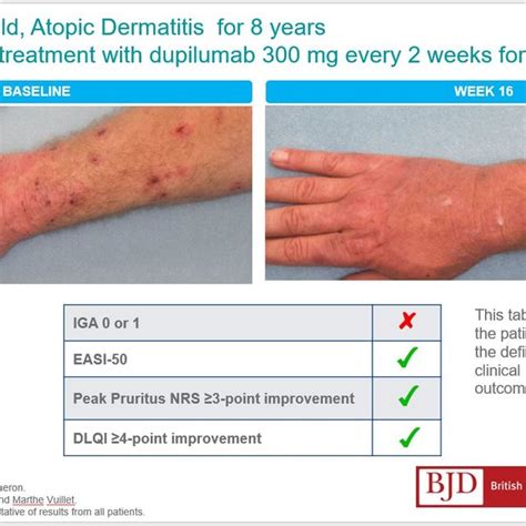 Example Of Case Before And After Treatment With Dupilumab 300mg Every Download Scientific