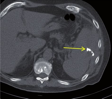 Ct Guided Percutaneous Drainage Of A Splenic Abscess Case Report And