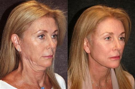 Facelift Surgery Facial Rejuvenation Facelift Procedure Sagging