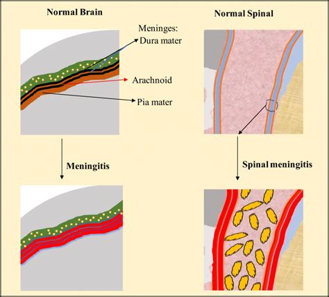 Pictorial Representation Portraying Inflammation Of The Meninges In