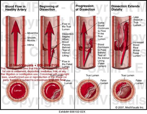 Medivisuals Stages Of Dissection Medical Illustration
