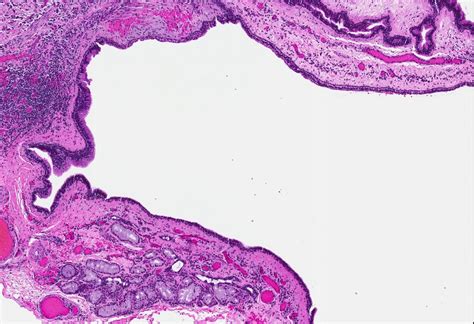 Nasolabial Cyst Histology