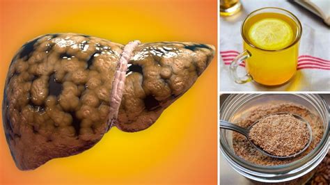 How Ayurveda Treat Liver Cirrhosis With Diet And Herbal Remedies