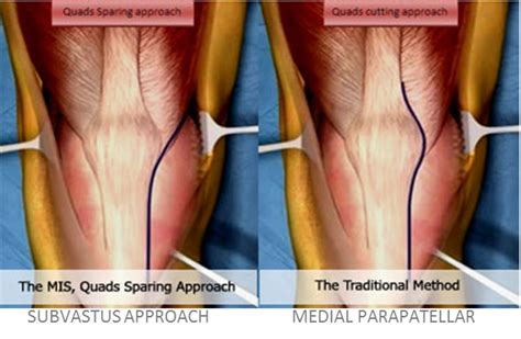 Knee Muscle Sparing Approach Hofmann Arthritis Institute