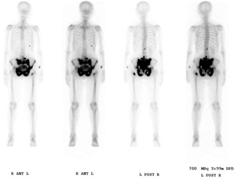 A Technetium 99 M Bone Scan Revealed Widespread Osteolytic And