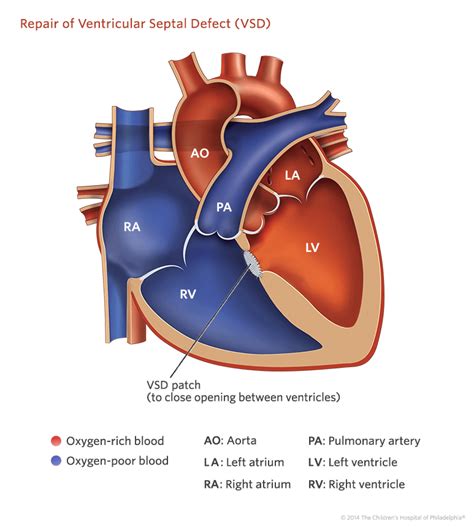 Ventricular Septal Defect By Blair Fitzgerald Infographic In 2020