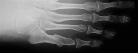 5th Metatarsal Fracture Dr Ben Beamond Adelaide