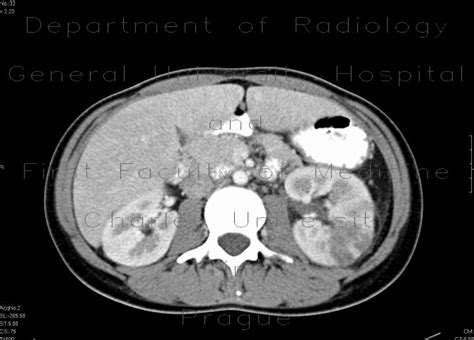 Radiology Case Acute Pyelonephritis Left Kidney