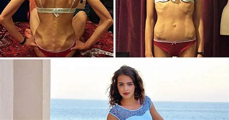 Before And After Pics Of People Who Defeated Anorexia Album On Imgur