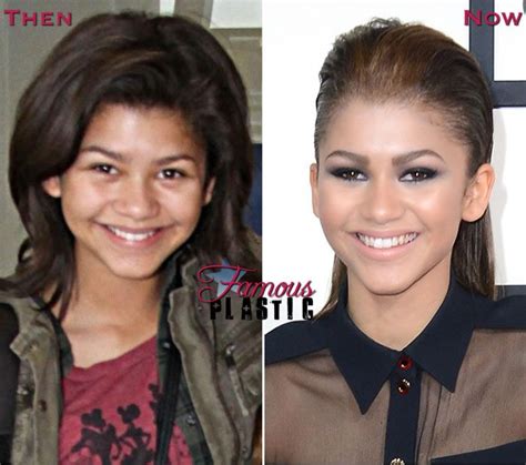 Zendaya Plastic Surgery 2014 Before And After Pictures