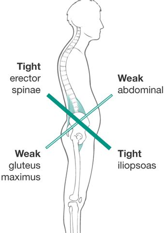 The joint of your hip is located near your spine. Do Tight Hip Flexors Correlate to Glute Weakness?