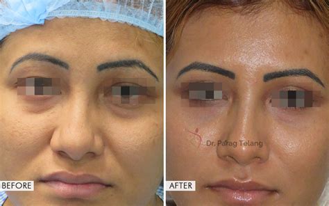 Results Blepharoplasty Surgery Before And After