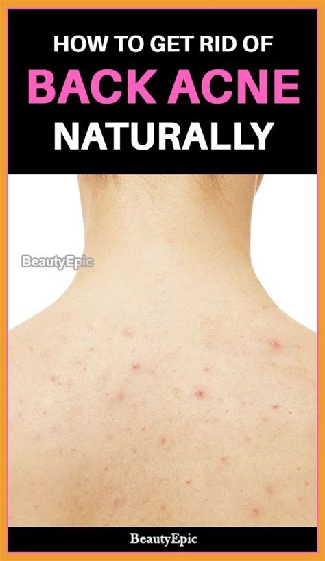 How To Get Rid Of Back Acne Fast Naturally How I Got Rid Of My Body