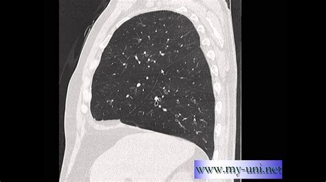 Anatomy Normal Anatomy Of Right Lung On Ct Youtube