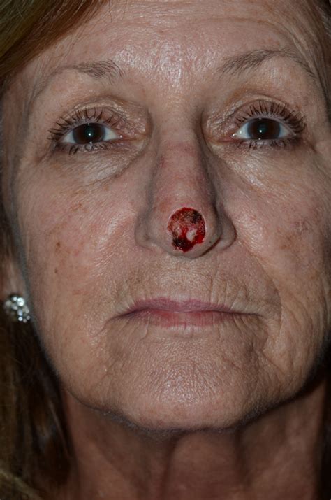 Indianapolis Skin Cancer Reconstruction Before And After Photos