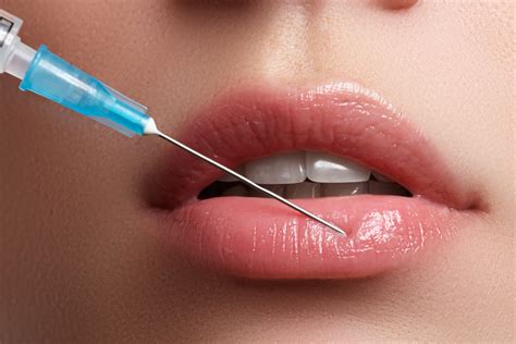 8 things to know if you re considering lip injections radiance skincare and laser medspa