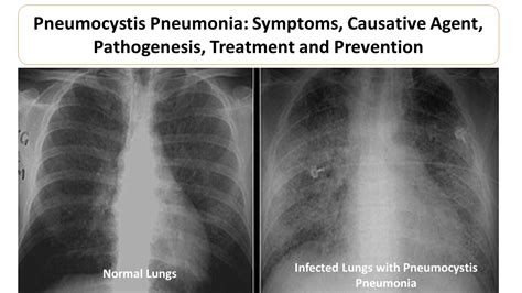 Pneumocystis Jiroveci Pneumonia Pcp