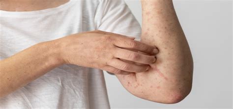 Stress Rash Early Signs Diagnosis And Treatment