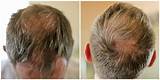 Images of My Hair Is Thinning On The Sides Male